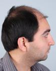 Before Hair Transplant&nbsp;Front